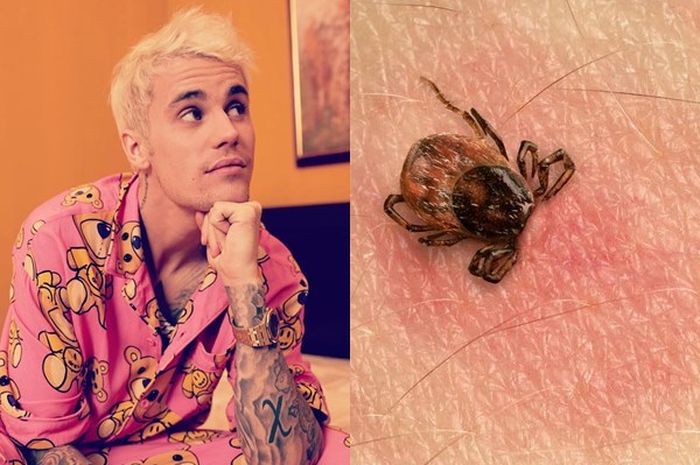 Kenali Penyakit Lyme Yang Dialami Justin Bieber